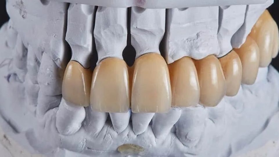 Full-Mouth-Rehabilitation-1